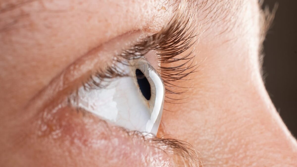 Keratokonus Hakkında Sık Sorulan Sorular
