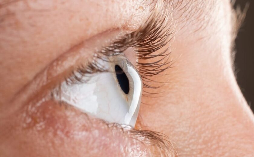 Keratokonus Hakkında Sık Sorulan Sorular