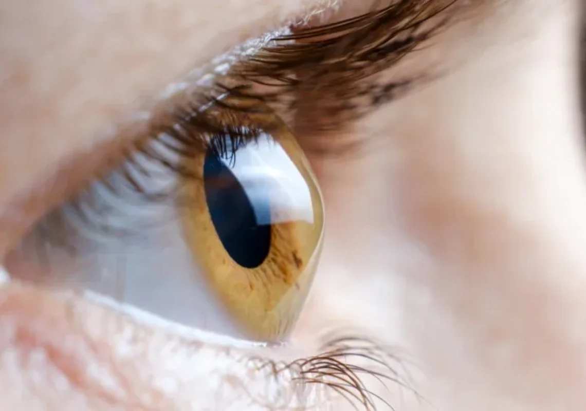 Keratokonus Nedir?