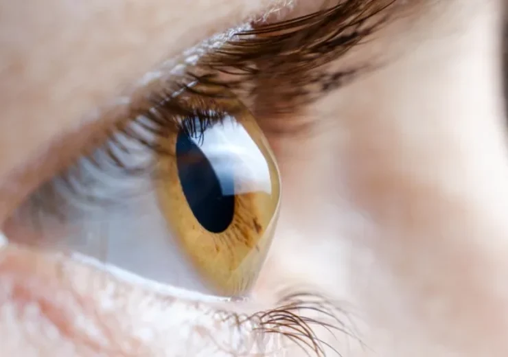 Keratokonus Nedir?