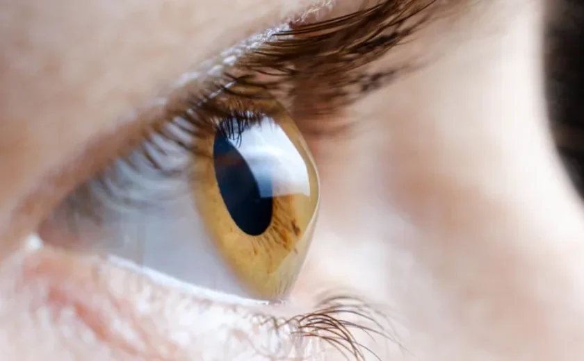 Keratokonus Nedir?