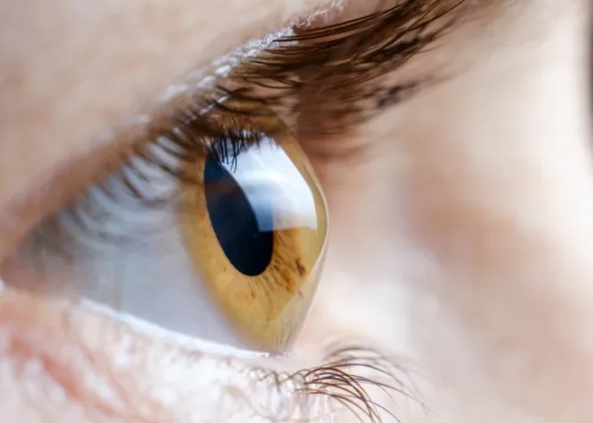 Keratokonus Nedir?